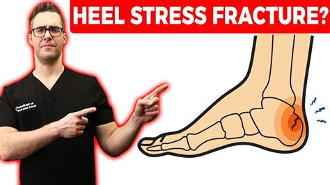 youtube calcaneal compression test|calcaneal stress fracture squeeze test.